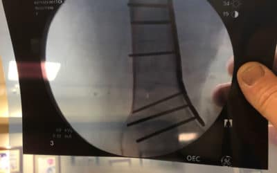 Jeannette is out of surgery (4-29am)